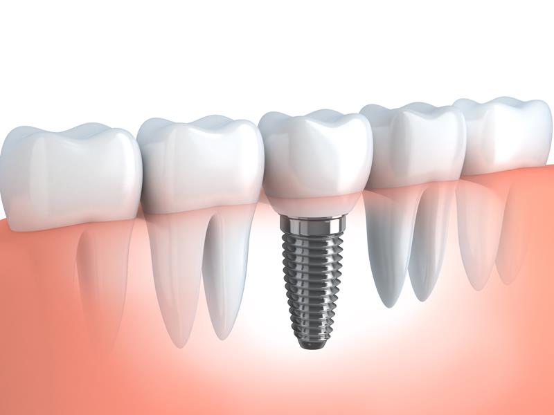 Dental Implants  Butler, IN 