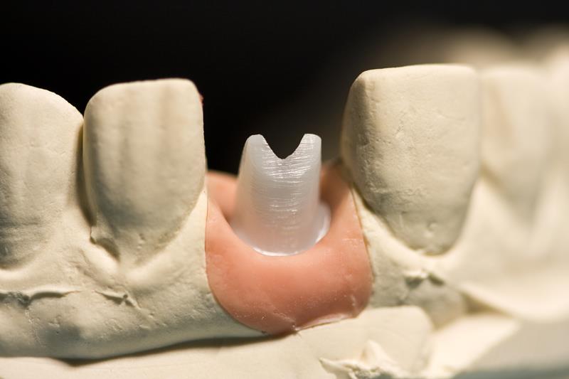 Implant Restoration  Butler, IN 
